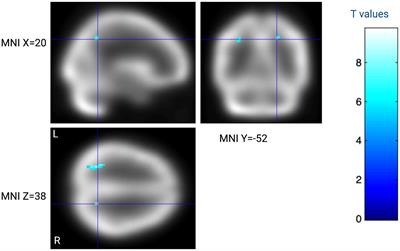 Is brain perfusion correlated to switching mood states and cognitive impairment in bipolar disorder type I? A longitudinal study using perfusion imaging approach